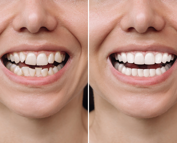Les problèmes Quels problèmes peut-on corriger avec Invisalign ?