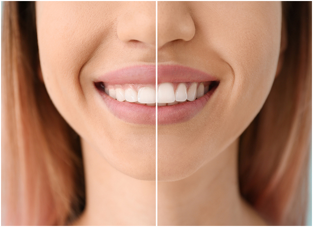 Quand envisager une chirurgie esthétique des gencives ? Quand envisager une chirurgie esthétique des gencives ?
