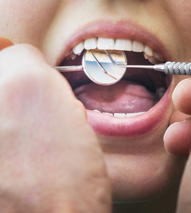 Comment traitons-nous les caries Comment traitons-nous les caries ?