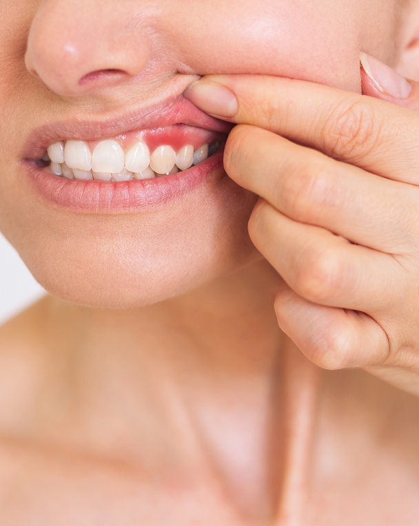 Comprendre les maladies des gencives Comprendre les maladies des gencives