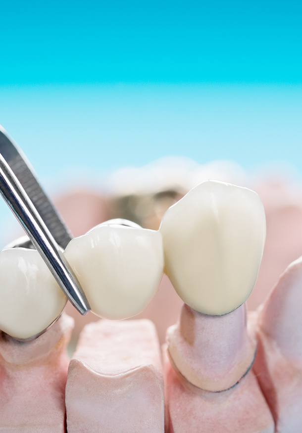 Le pont : remplacer une ou plusieurs dents manquantes Le pont : remplacer une ou plusieurs dents manquantes